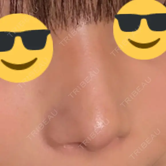 鼻尖形成（切開） / ワシ鼻修正・ハンプ切除 / 眉間プロテーゼ / 鼻柱下降・鼻唇角形成（猫手術） / ヒアルロン酸注入（額） グローバルビューティークリニック 大阪院 DAY 155 メイン用