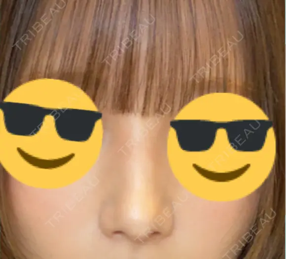 鼻尖形成（切開） / ワシ鼻修正・ハンプ切除 / 眉間プロテーゼ / 鼻柱下降・鼻唇角形成（猫手術） / ヒアルロン酸注入（額） グローバルビューティークリニック 大阪院 DAY 232 メイン用