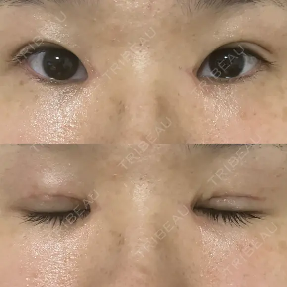 二重切開 / 目頭切開 EMMA CLINIC（エマクリニック） AFTER メイン用