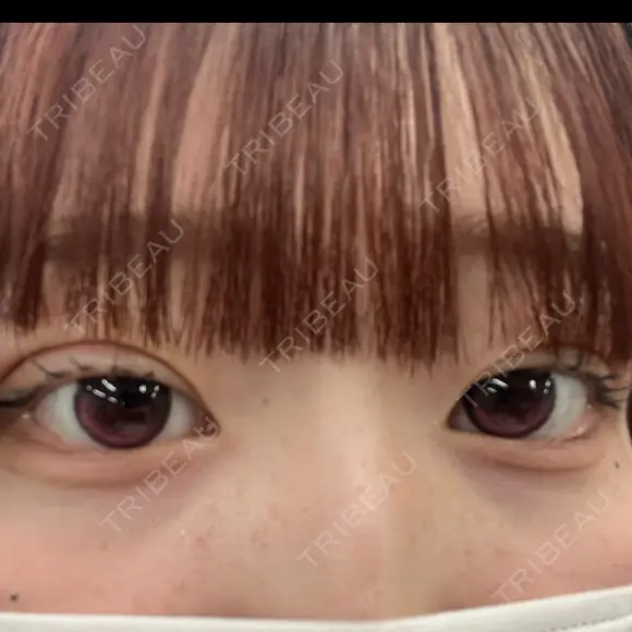 二重埋没 アリエル美容クリニック 郡山院 DAY 3 メイン用