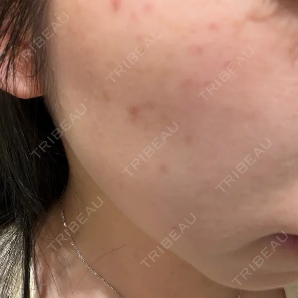 ルメッカ MEMOTO CLINIC 名古屋 DAY 0 メイン用