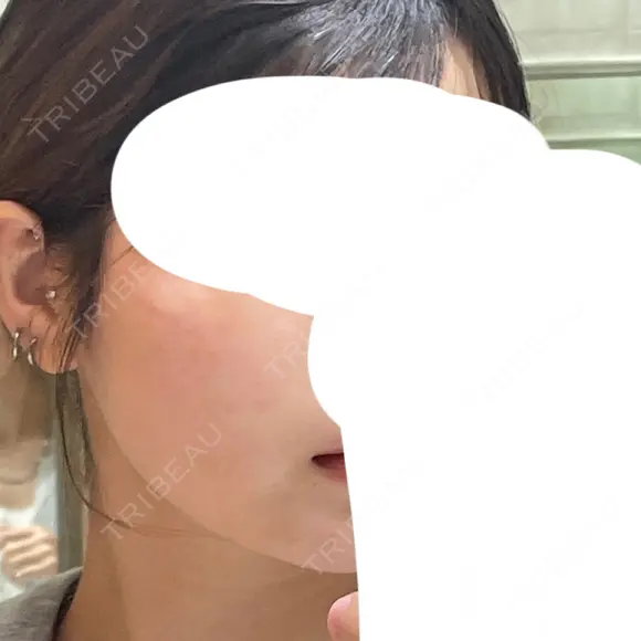 インモード 小倉美容外科/美容皮膚科 ビラビューティークリニック DAY 0 メイン用