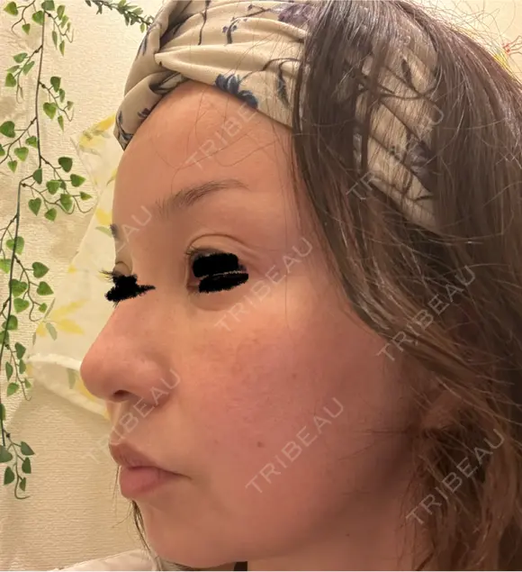 タレ目形成・グラマラスライン（埋没） Zetith Beauty Clinic 銀座院 DAY 7 メイン用