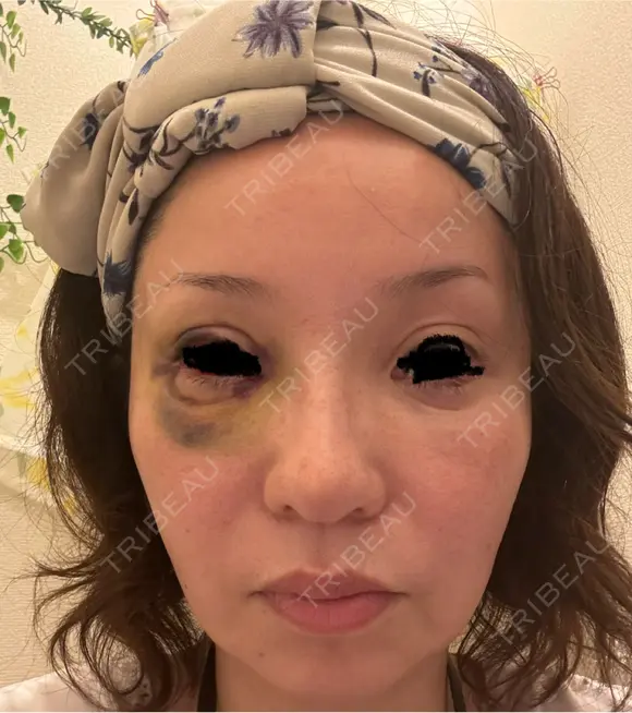 タレ目形成・グラマラスライン（埋没） Zetith Beauty Clinic 銀座院 DAY 7 メイン用