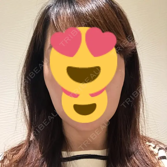 ボトックス（エラ・小顔） 湘南美容クリニック 京都院 AFTER メイン用