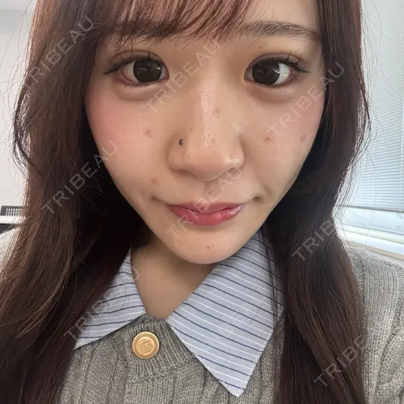 二重埋没 / ほくろ・いぼ切除（肌） / 上まぶたの脂肪取り / タレ目形成・グラマラスライン（切開） / 目元修正 / ボトックス（眉間） 藤・ナチュレ美容クリニック 銀座院 DAY 7 メイン用