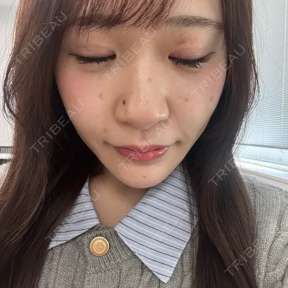 二重埋没 / ほくろ・いぼ切除（肌） / 上まぶたの脂肪取り / タレ目形成・グラマラスライン（切開） / 目元修正 / ボトックス（眉間） 藤・ナチュレ美容クリニック 銀座院 DAY 7 メイン用