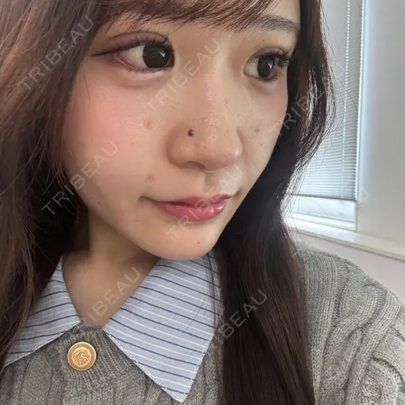 二重埋没 / ほくろ・いぼ切除（肌） / 上まぶたの脂肪取り / タレ目形成・グラマラスライン（切開） / 目元修正 / ボトックス（眉間） 藤・ナチュレ美容クリニック 銀座院 DAY 7 メイン用