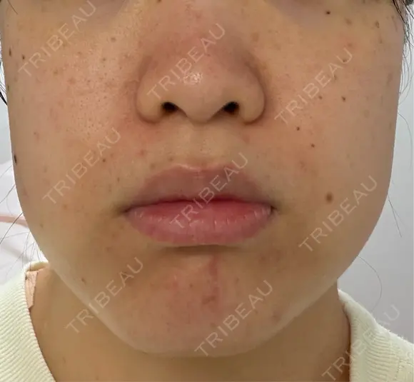 ピーリング（ニキビ・毛穴） ルラ美容クリニック 池袋院 AFTER メイン用