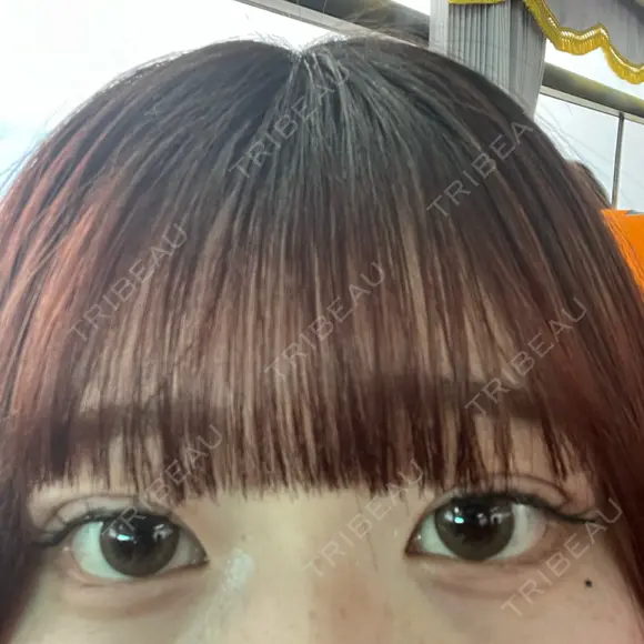 二重埋没 アリエル美容クリニック 郡山院 DAY 4 メイン用