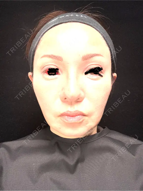 タレ目形成・グラマラスライン（埋没） Zetith Beauty Clinic 銀座院 DAY 9 メイン用