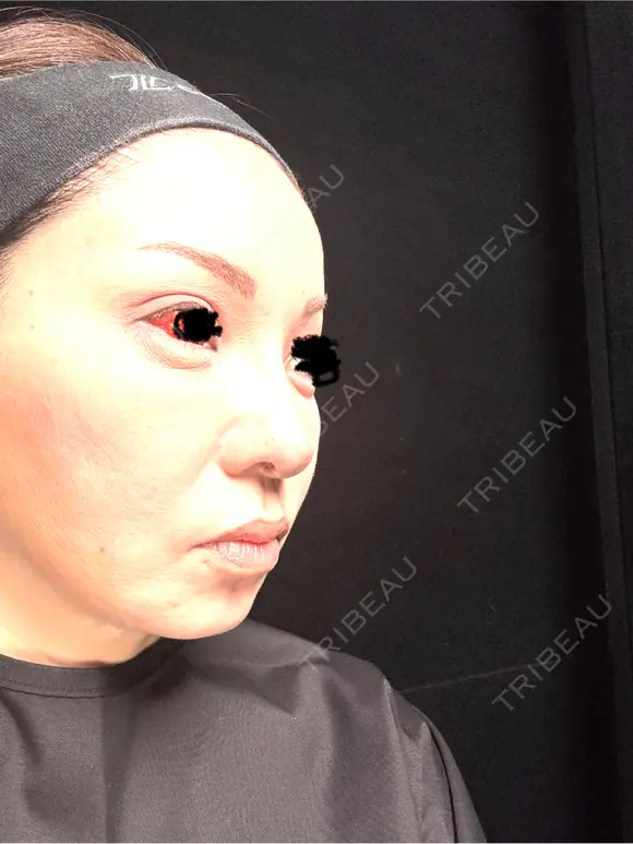 タレ目形成・グラマラスライン（埋没） Zetith Beauty Clinic 銀座院 DAY 9 メイン用