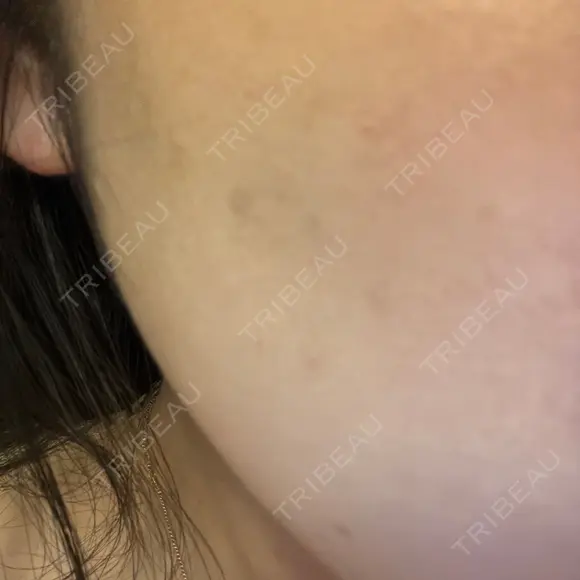 ルメッカ MEMOTO CLINIC 名古屋 DAY 2 メイン用