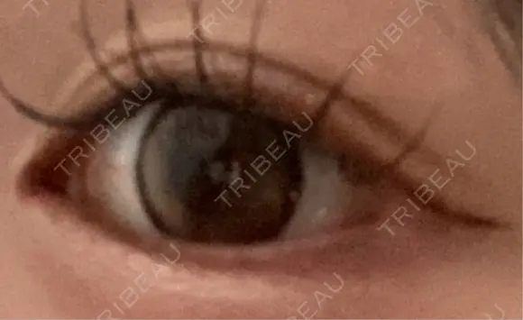 目尻切開 / タレ目形成・グラマラスライン（切開） R Beauty CLINIC 大阪院 AFTER メイン用