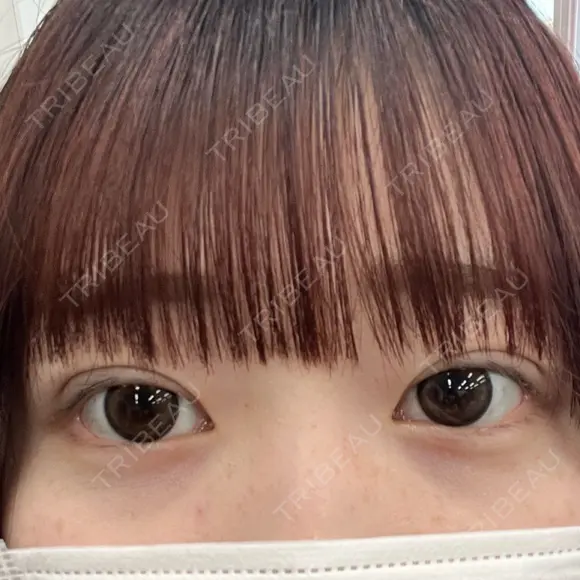 二重埋没 アリエル美容クリニック 郡山院 DAY 6 メイン用