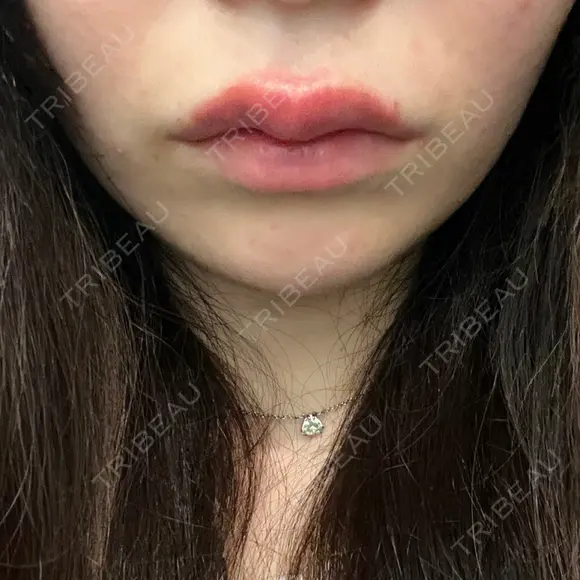 ヒアルロン酸注入（涙袋） / ヒアルロン酸注入（唇） PRO CLINIC プロクリニック 銀座院 DAY 0 メイン用