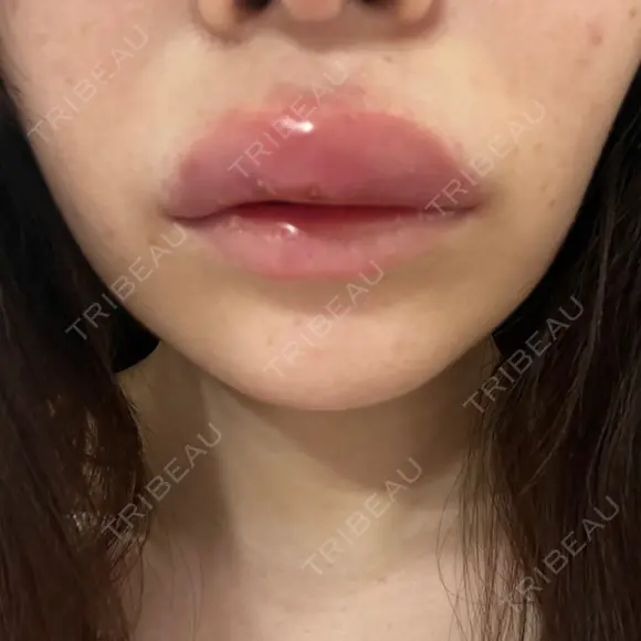 ヒアルロン酸注入（涙袋） / ヒアルロン酸注入（唇） PRO CLINIC プロクリニック 銀座院 DAY 1 メイン用