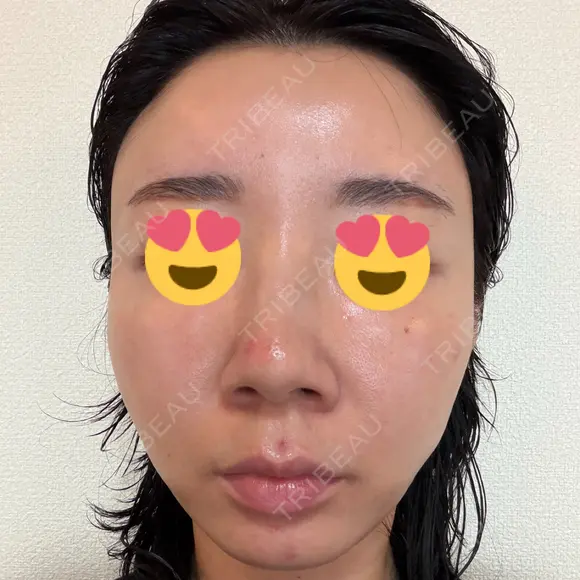糸リフト / 脂肪吸引（顔） EMMA CLINIC（エマクリニック） AFTER メイン用