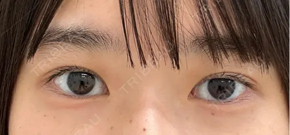 二重埋没 eクリニック 那覇院 AFTER メイン用