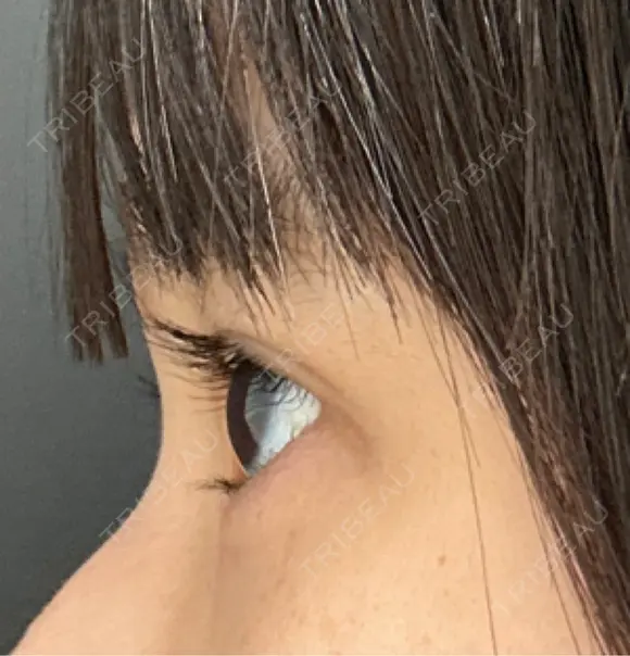 二重埋没 eクリニック 那覇院 DAY 27 メイン用