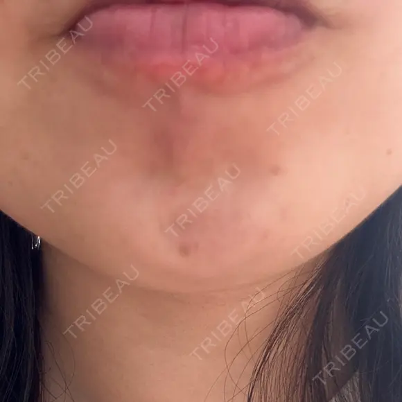 ボトックス（エラ・小顔） BISIN GINZA CLINIC AFTER メイン用