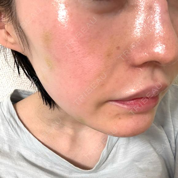 肌育注射（ジュベルックなど） ハナビューティークリニック DAY 4 メイン用