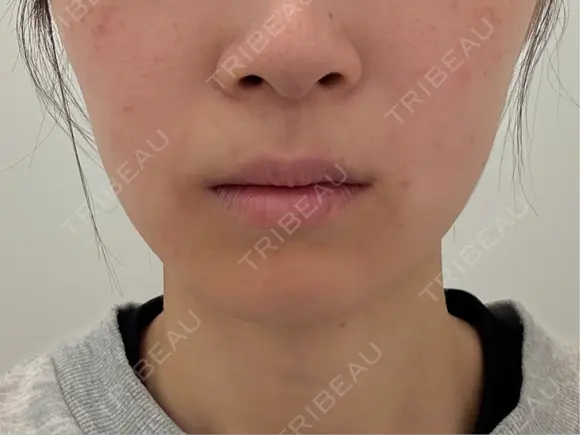ボトックス（エラ・小顔） PRO CLINIC プロクリニック 銀座院 AFTER メイン用
