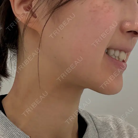 ボトックス（エラ・小顔） PRO CLINIC プロクリニック 銀座院 DAY 0 メイン用