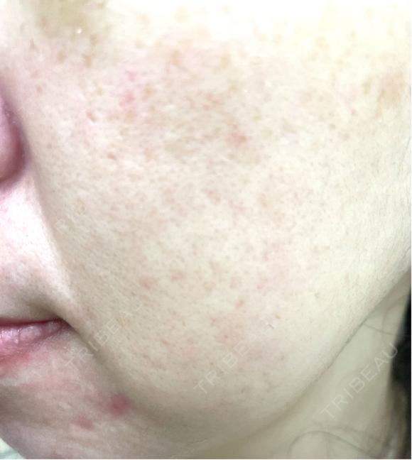 ルメッカ Evergreen medical clinic DAY 37 メイン用