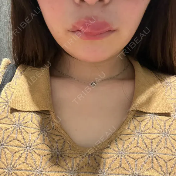 ヒアルロン酸注入（涙袋） / ヒアルロン酸注入（唇） PRO CLINIC プロクリニック 銀座院 AFTER メイン用