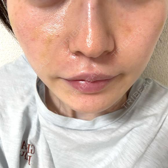 肌育注射（ジュベルックなど） ハナビューティークリニック DAY 5 メイン用