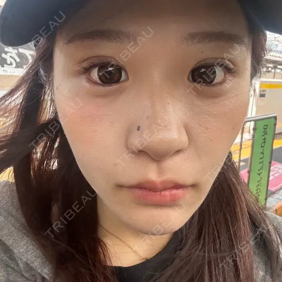 二重埋没 / ほくろ・いぼ切除（肌） / 上まぶたの脂肪取り / タレ目形成・グラマラスライン（切開） / 目元修正 / ボトックス（眉間） 藤・ナチュレ美容クリニック 銀座院 DAY 15 メイン用