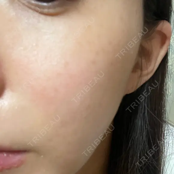 LDM・インテンスウルトラ Ledian Clinic六本木 DAY 6 メイン用