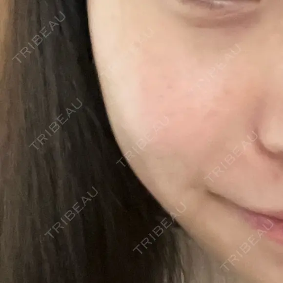 LDM・インテンスウルトラ Ledian Clinic六本木 DAY 7 メイン用