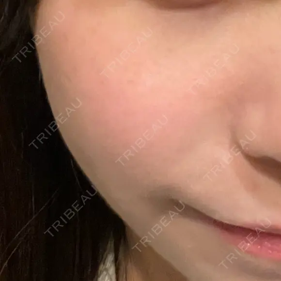 LDM・インテンスウルトラ Ledian Clinic六本木 DAY 8 メイン用