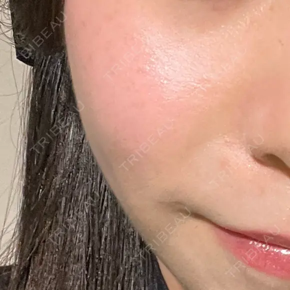 LDM・インテンスウルトラ Ledian Clinic六本木 AFTER メイン用