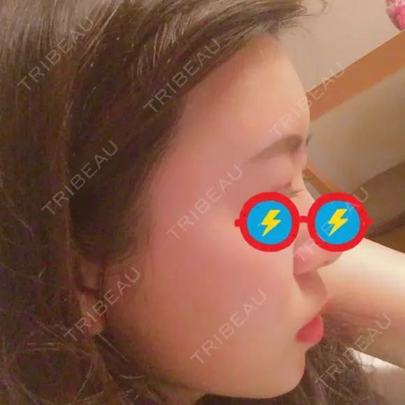 額を丸く エートップ美容整形外科 DAY 42 メイン用