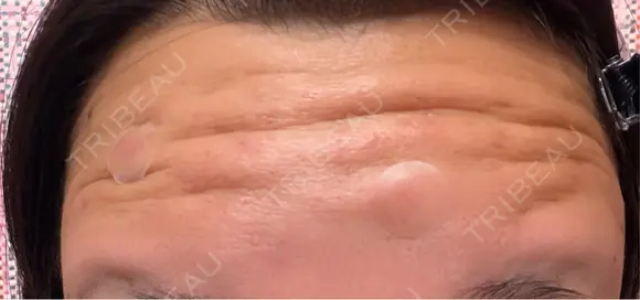 ボトックス（額） 神戸スイミー皮膚科美容外科 DAY 0 メイン用