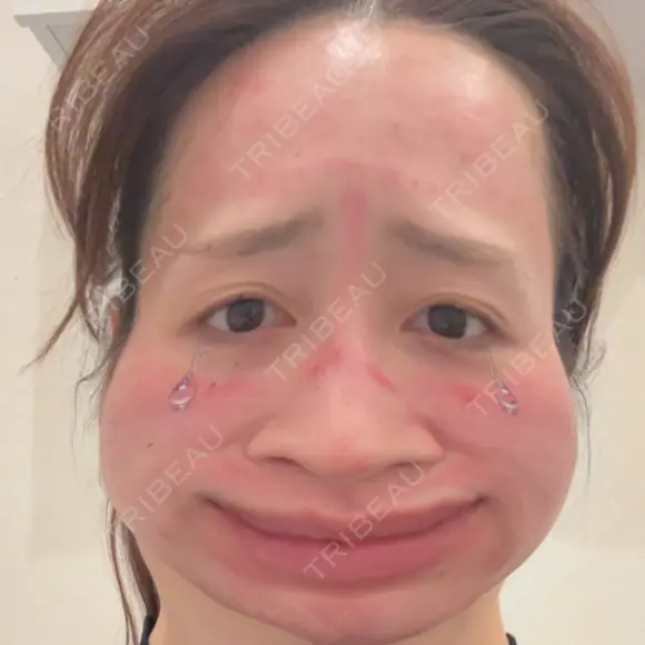 ダーマペン L‘amour clinic Tokyo【ラムールクリニック東京】 AFTER メイン用