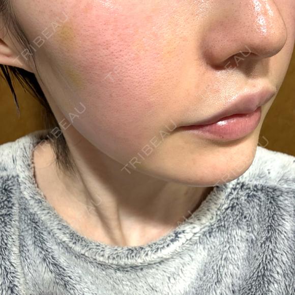肌育注射（ジュベルックなど） ハナビューティークリニック DAY 7 メイン用