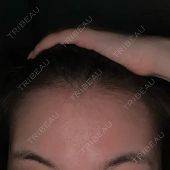 ボトックス（額） 池袋美容クリニック DAY 50 メイン用