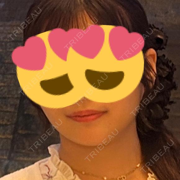 バッカルファット除去 / 脂肪吸引（顔） / メーラーファット除去 / ヒアルロン酸注入（あご） PRISM Beauty Clinic 町田院 AFTER メイン用