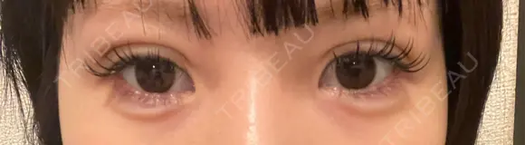 二重埋没 広島本通り美容クリニック DAY 7 メイン用