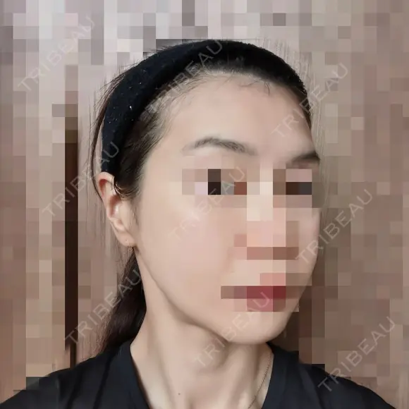 ボトックス（エラ・小顔） 品川美容外科 仙台院 DAY 3 メイン用