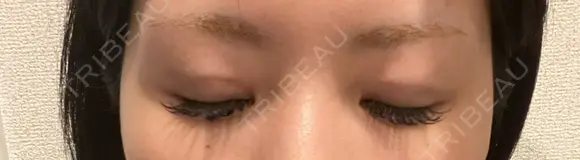 二重埋没 広島本通り美容クリニック DAY 8 メイン用