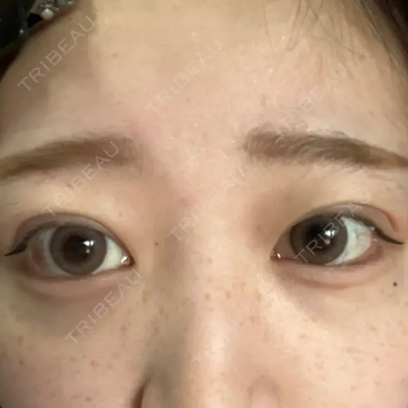 二重埋没 アリエル美容クリニック 郡山院 DAY 15 メイン用