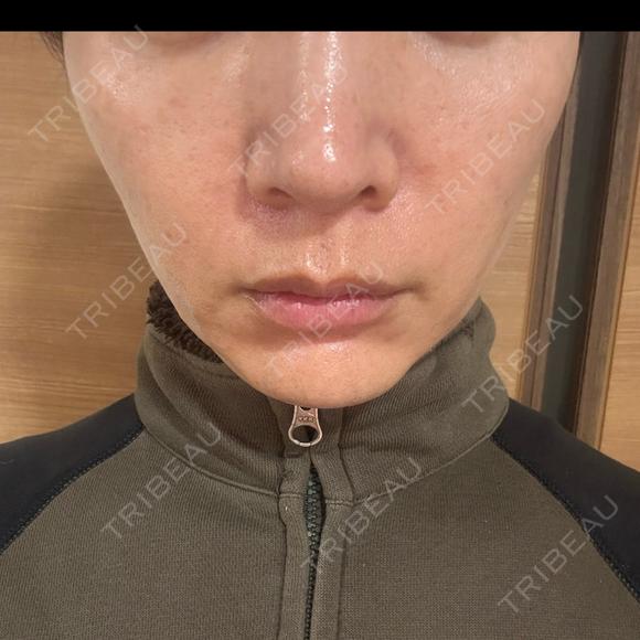 デンシティ 湘南美容クリニック 豊田院 DAY 1 メイン用