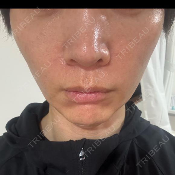 デンシティ 湘南美容クリニック 豊田院 DAY 4 メイン用