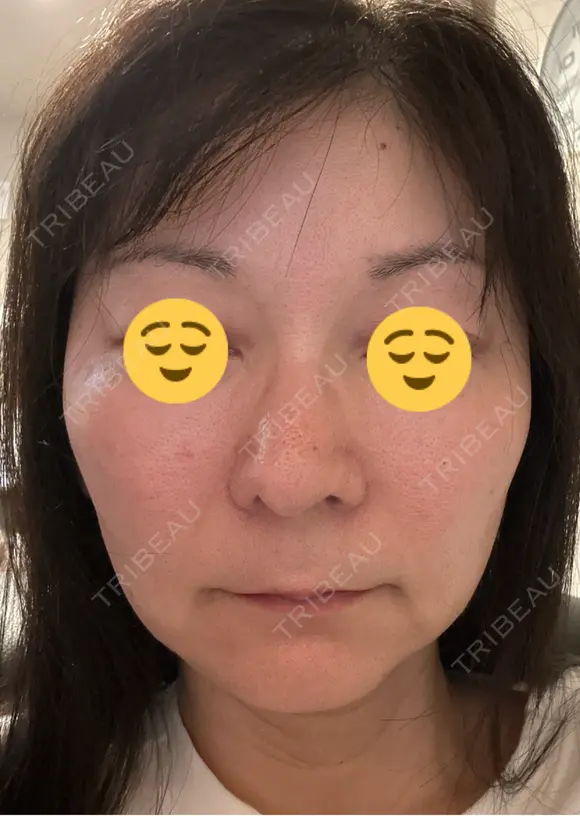エレクトロポレーション 湘南美容クリニック 松戸院 AFTER メイン用