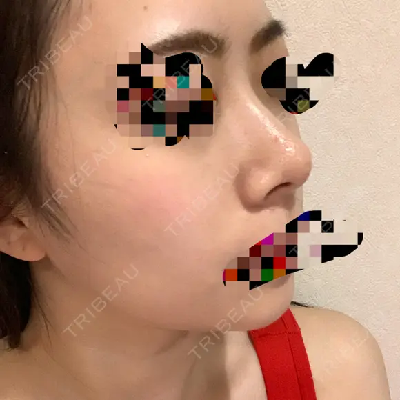 小鼻縮小（切開） / スレッドノーズ / 鼻尖縮小 / ヒアルロン酸注入（鼻） キップン整形外科 DAY 17 メイン用